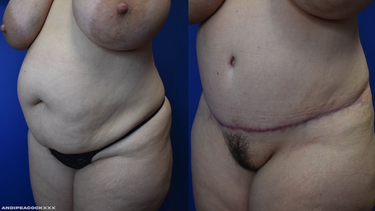 MILF Transformation: Mature Beauty Gets Tummy Tuck